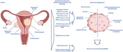 Angiogenesis and uterine fibroids
